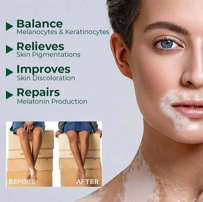 Dermacare Vitiligo Herbal Aloe Vera & Mint Care Cream